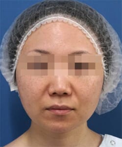 小顔脂肪吸引(ホホ・アゴ下) 手術前 正面