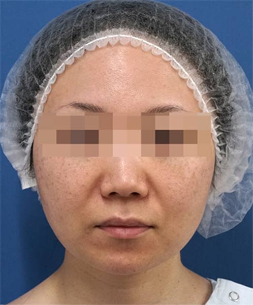 小顔脂肪吸引(ホホ・アゴ下) 手術前 正面