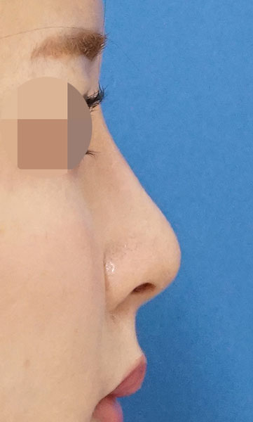 鼻尖縮小+軟骨移植+ストラット、鼻孔縁下降、プロテーゼ　３ヶ月後　　右側面のAfterの写真