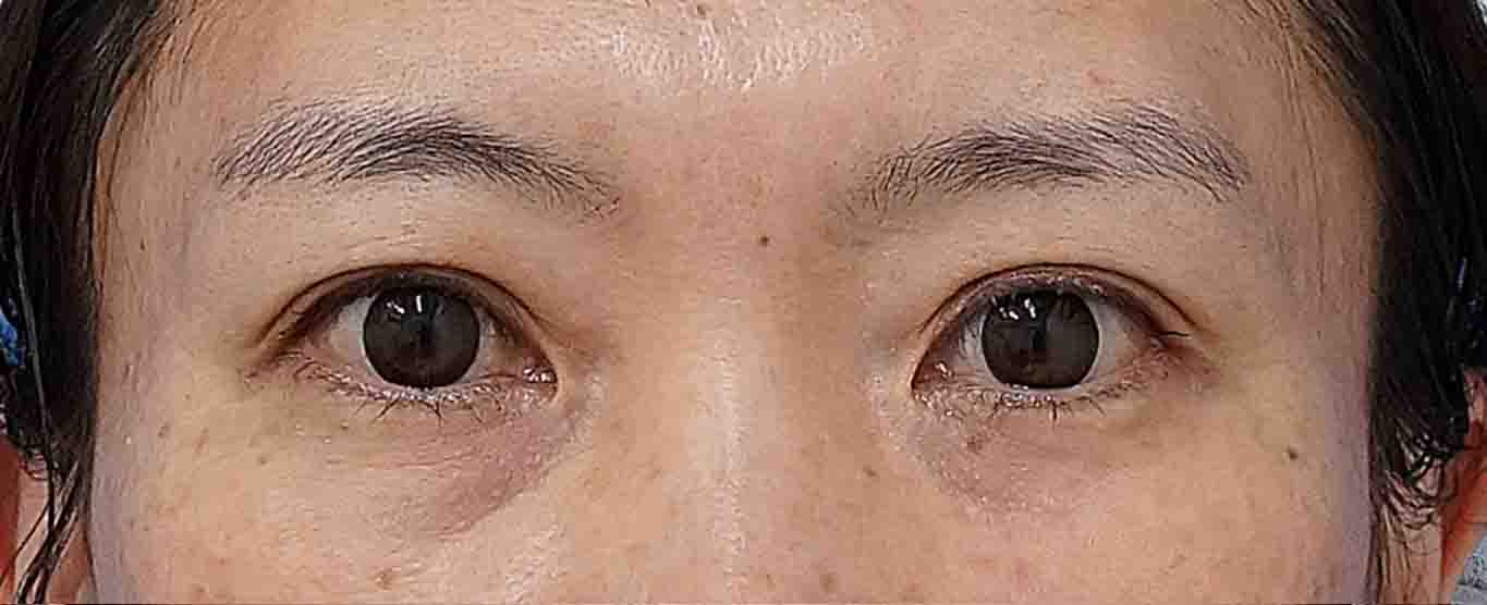 二重埋没法（２点連結表止め、もとびアイライト）　１か月後のAfterの写真