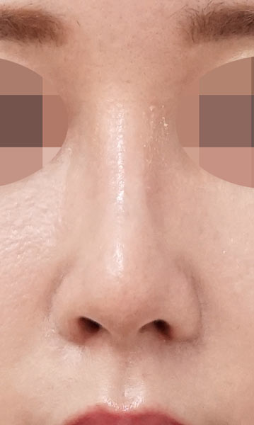 鼻尖縮小+軟骨移植+ストラット、鼻孔縁下降、プロテーゼ　３ヶ月後　正面のAfterの写真