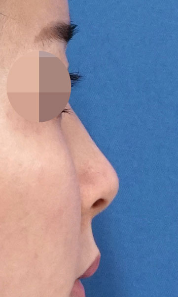 鼻尖縮小+軟骨移植+ストラット、鼻孔縁下降、プロテーゼ　３ヶ月後　　右側面のBefore写真
