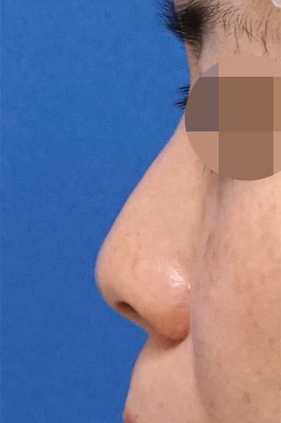 鼻尖縮小＋軟骨移植＋ストラット　１ヶ月後　左側面のBefore写真