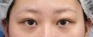 眉下切開+目の上脂肪とり 術前