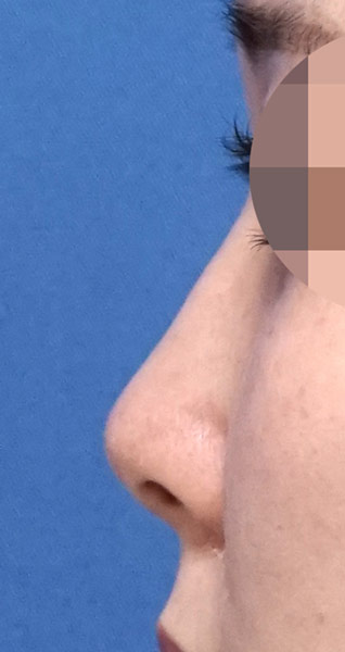 鼻尖縮小+軟骨移植+ストラット、鼻孔縁下降、プロテーゼ　３ヶ月後　左側面のBefore写真