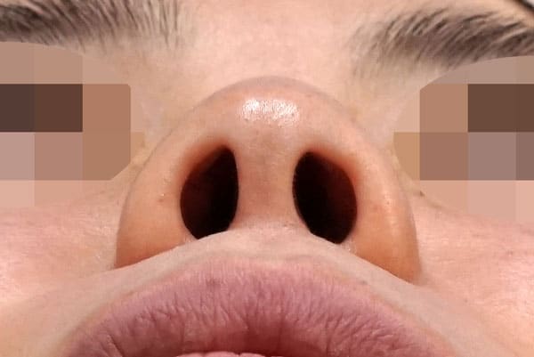 鼻尖縮小＋軟骨移植＋ストラット　１ヶ月後　下からのBefore写真