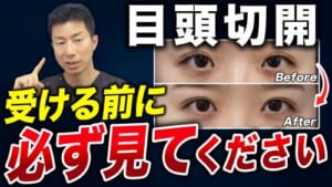 目頭切開を受けない方がいい人の特徴｜後から後悔しないために重要なこと