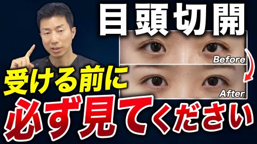 【医師が警告】目頭切開で「後悔する人」の共通点