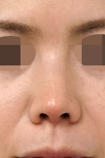 鼻尖縮小＋軟骨移植＋ストラット　１ヶ月後　正面のAfterの写真