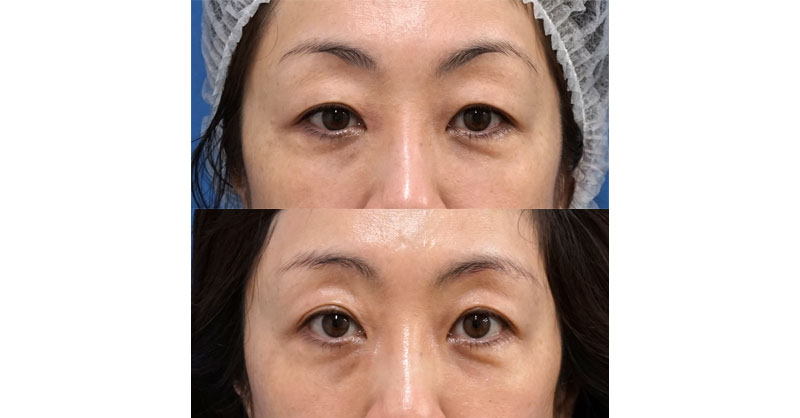 眉下切開で目元を明るく若々しく｜眉下切開　手術直後～6ヶ月後の経過