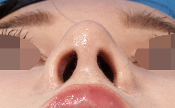 鼻尖縮小+軟骨移植+ストラット、鼻孔縁下降、プロテーゼ　３ヶ月後　下からのAfterの写真