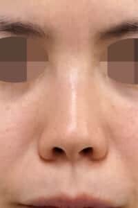 鼻尖縮小＋軟骨移植＋ストラット　術前　正面