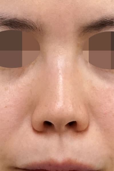 鼻尖縮小＋軟骨移植＋ストラット　１ヶ月後　正面のBefore写真