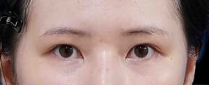 眉下切開(術後6か月)+二重埋没(術後3か月)