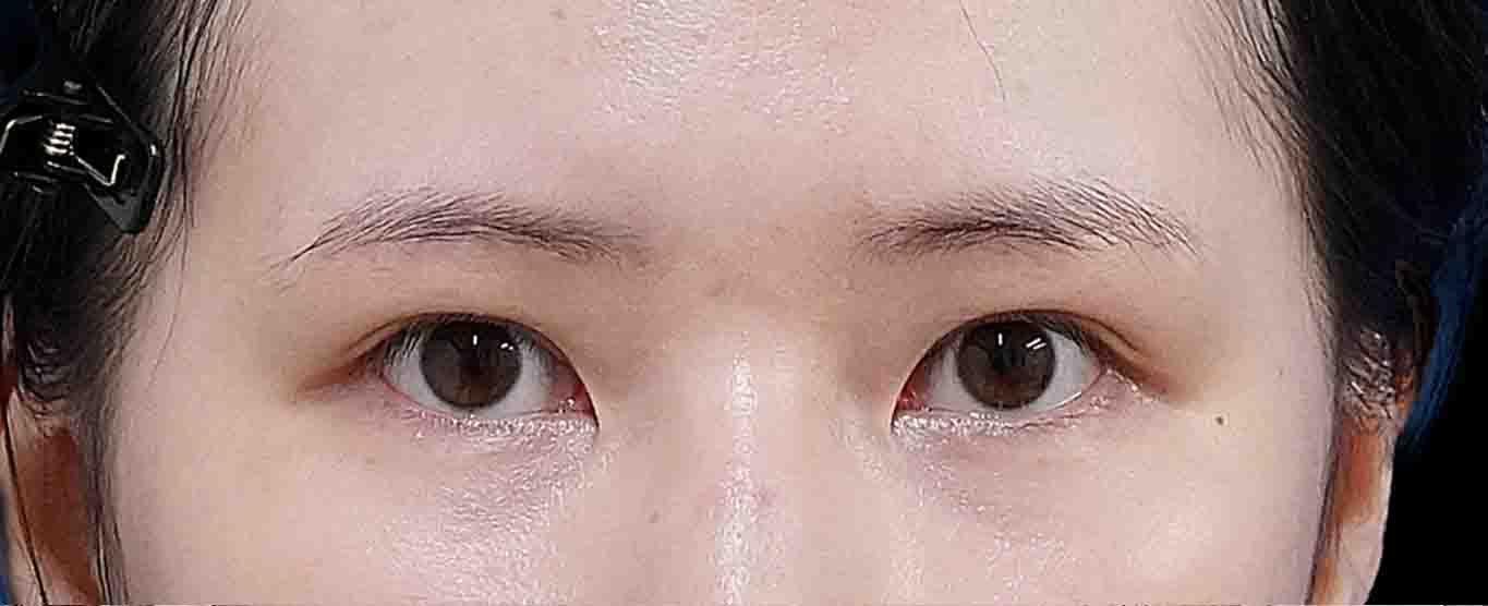 眉下切開 術後6か月、二重埋没（もとびアイゴールド） 術後3か月のAfterの写真