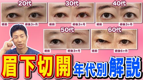 【眉下切開】たるみが取れるだけじゃない！治療の効果を年代別に徹底解説