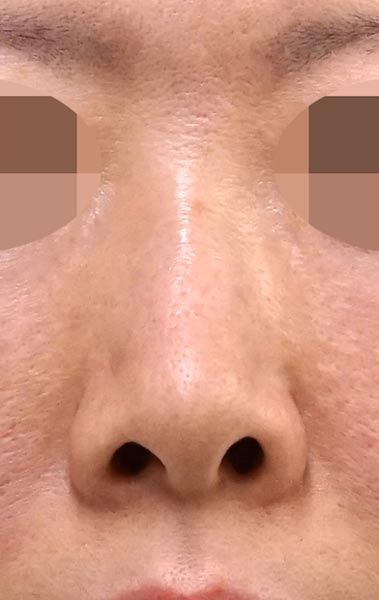 鼻尖縮小＋軟骨移植＋ストラット、鼻孔縁下降　３ヶ月後 　正面のBefore写真