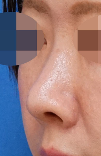 鼻尖縮小＋軟骨移植＋ストラット、鼻孔縁下降　３ヶ月後　左斜めのAfterの写真