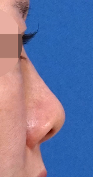 鼻尖縮小＋軟骨移植＋ストラット、鼻孔縁下降　３ヶ月後　右側面のBefore写真