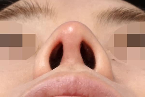 鼻尖縮小＋軟骨移植＋ストラット　１ヶ月後　下からのAfterの写真