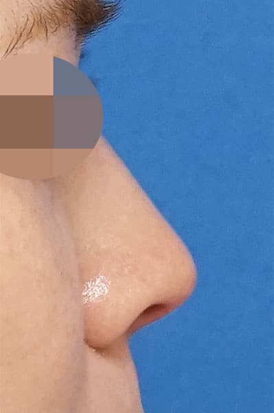鼻尖縮小＋軟骨移植＋ストラット　１ヶ月後　右側面のAfterの写真
