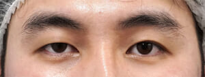 眉下切開+眼瞼下垂 術前