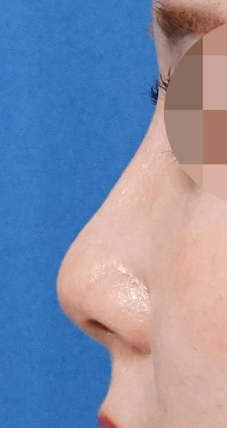 鼻尖縮小+軟骨移植+ストラット、鼻孔縁下降、プロテーゼ　３ヶ月後　左側面のAfterの写真