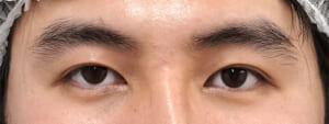 眉下切開+眼瞼下垂(眉下切開のみ)術前