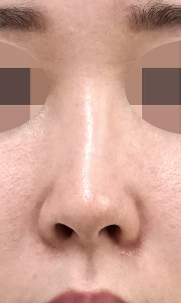 鼻尖縮小+軟骨移植+ストラット、鼻孔縁下降、プロテーゼ　３ヶ月後　正面のBefore写真
