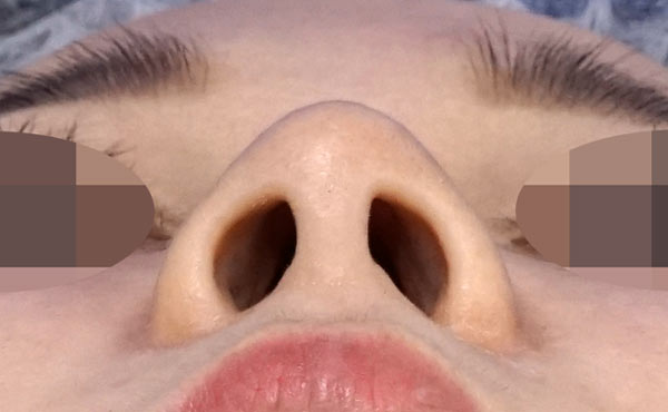 鼻尖縮小+軟骨移植+ストラット、鼻孔縁下降、プロテーゼ　３ヶ月後　下からのBefore写真