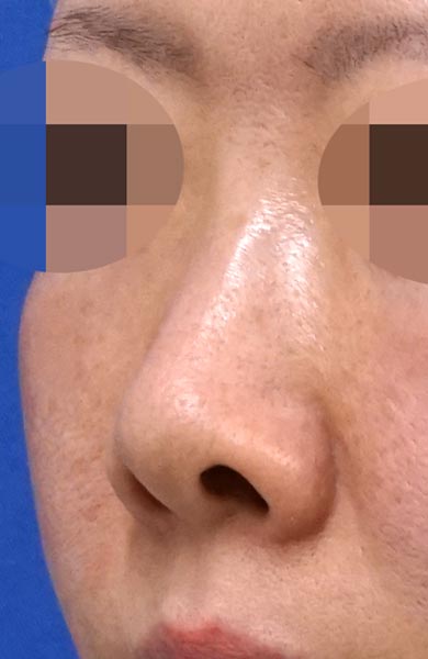 鼻尖縮小＋軟骨移植＋ストラット、鼻孔縁下降　３ヶ月後　左斜めのBefore写真