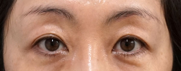 眉下切開　6ヶ月後のAfterの写真