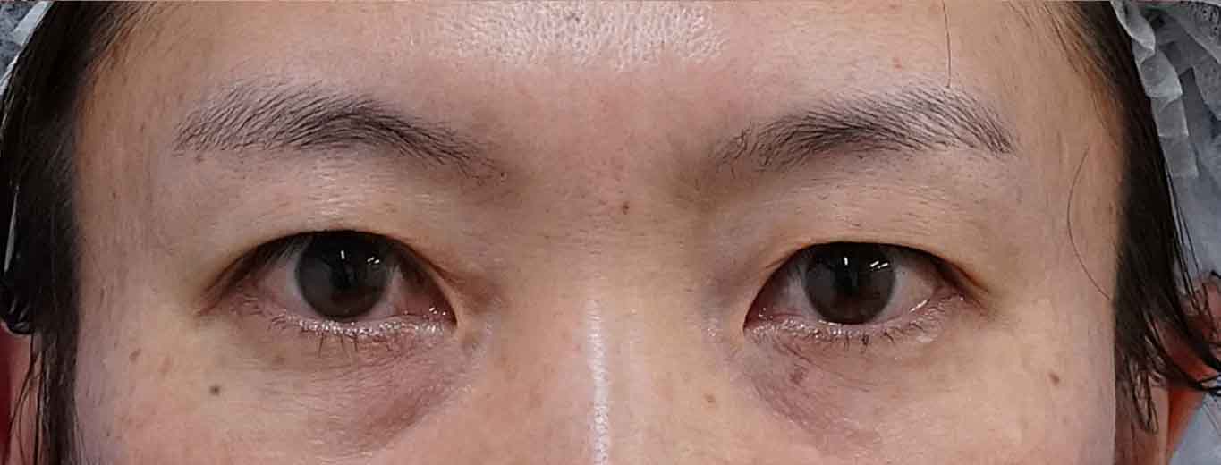 二重埋没法（２点連結表止め、もとびアイライト）　3か月後のBefore写真