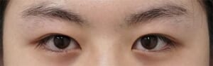 20代① 手術前