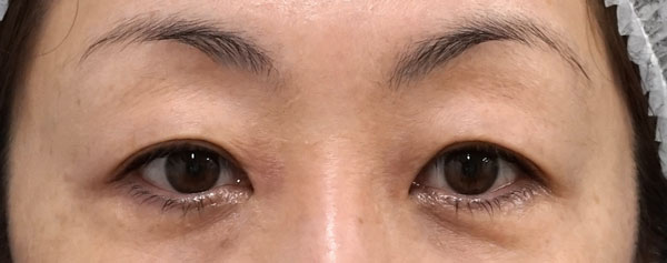 眉下切開　6ヶ月後のBefore写真