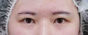 眉下切開(術直後)+二重埋没 術直後