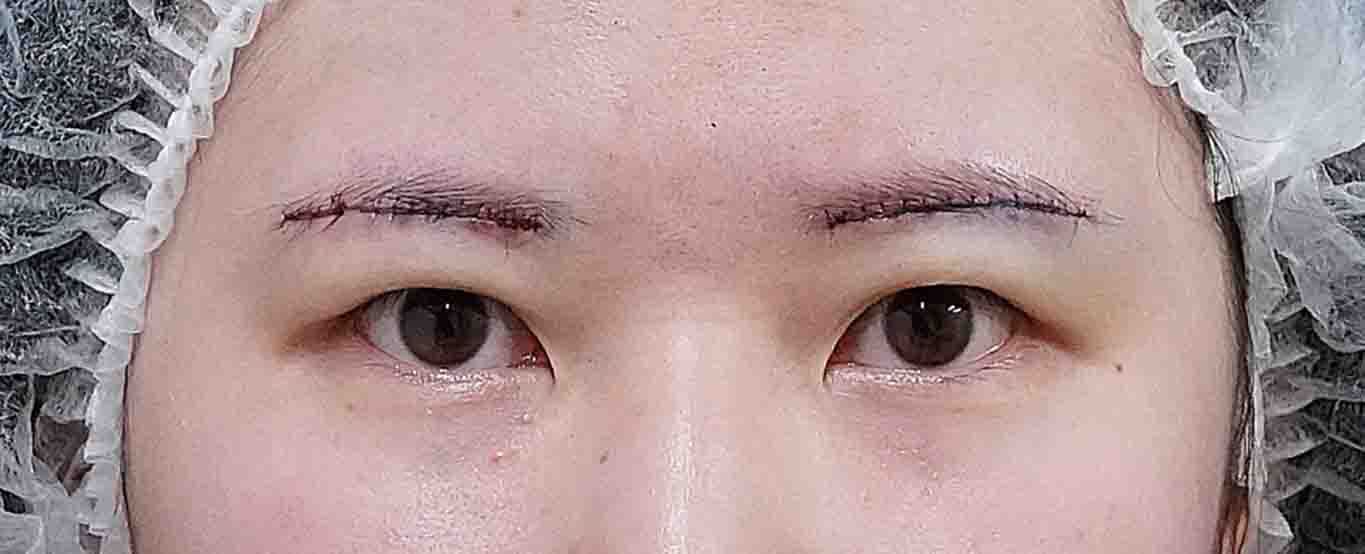 眉下切開 術直後のAfterの写真