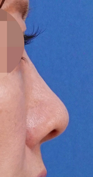 鼻尖縮小＋軟骨移植＋ストラット、鼻孔縁下降　３ヶ月後　右側面のAfterの写真