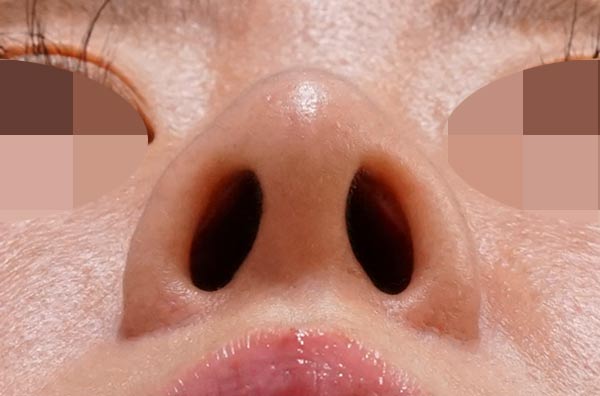 鼻尖縮小+軟骨移植+ストラット、鼻孔縁下降 3か月後 下から