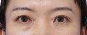 もとびアイライト 術後3か月