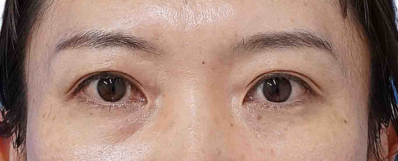 二重埋没法（２点連結表止め、もとびアイライト）　3か月後のAfterの写真