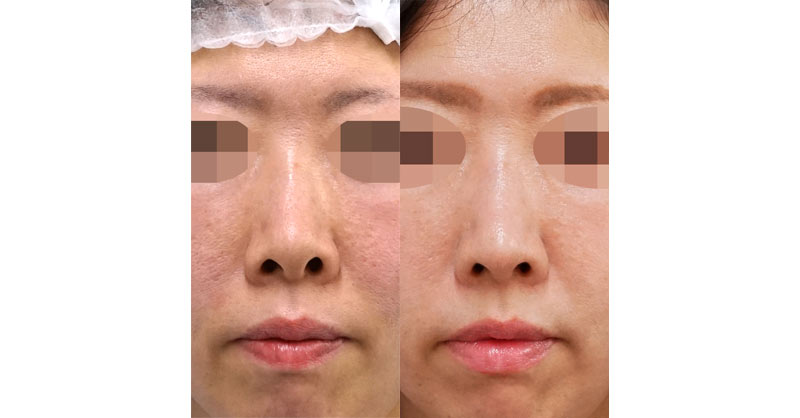 鼻孔縁下降も組み合わせてより鼻の穴を目立ちにくく｜鼻尖縮小＋軟骨移植＋ストラット、鼻孔縁下降　３ヶ月後