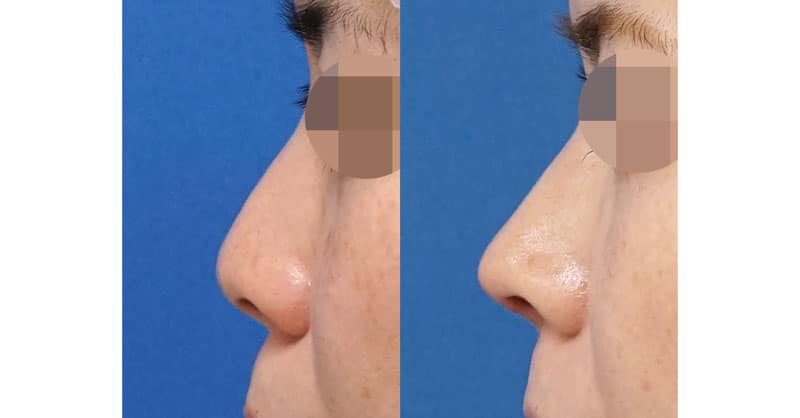 ストラットを組み合わせて鼻先をよりシュッとさせる｜鼻尖縮小＋軟骨移植＋ストラット　１ヶ月後