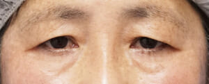 60代 手術前