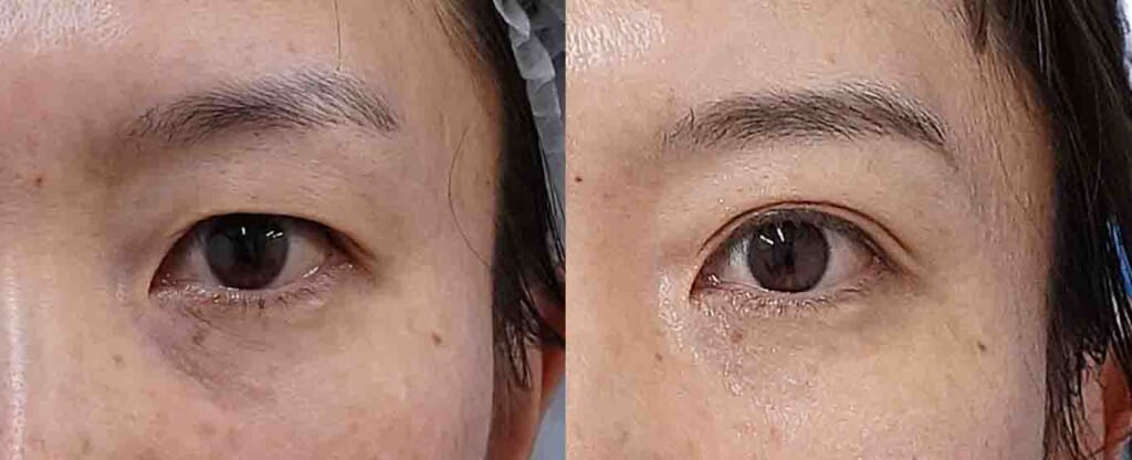 まぶたのたるみに二重埋没法｜眉下切開ではなく埋没法を選択した症例