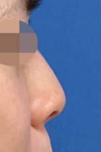 鼻尖縮小＋軟骨移植＋ストラット　術前　右側面