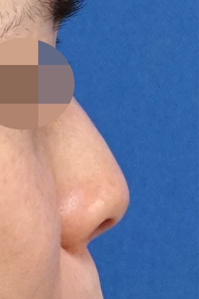 鼻尖縮小＋軟骨移植＋ストラット　１ヶ月後　右側面のBefore写真