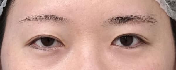 眉下切開、二重全切開・挙筋前転（眼瞼下垂）　６ヶ月後のBefore写真
