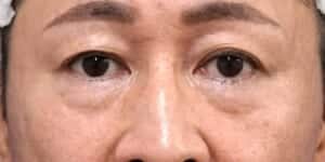 目の下脂肪取り・脂肪注入　手術前