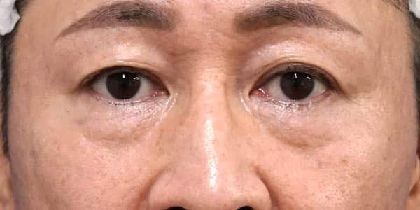 目の下脂肪取り・脂肪注入　手術前